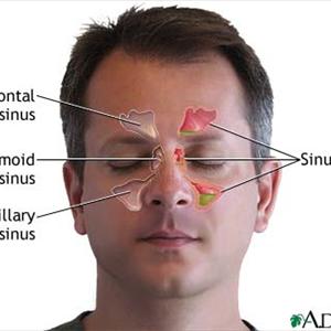 Maxillary Sinuses Patients - Sinus Infection Symptoms, Antibiotics, And Alternative Medicine
