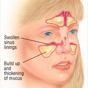 Headache Sinusitis - What Is Paranasal Sinus?