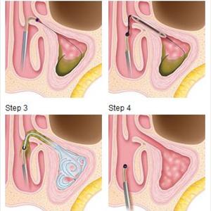 Help Clear Sinuses - Sinusitis Treatments