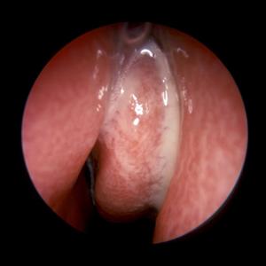 Sinusitis Ear Infection - Dealing With Sinusitis