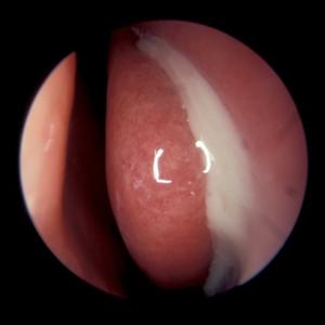 Sinusitis Medical Management 