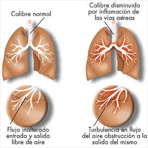 Chronic Sinusitis Forums - Sinusitis Treatment - Help Is On The Way