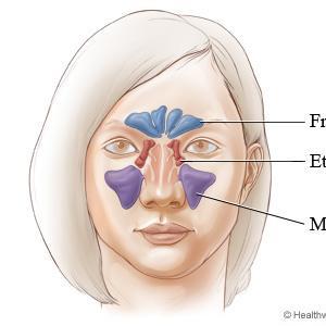 Sinuses Causes - How To Get Rid Of Sinus Pain?