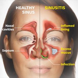 Sinusitis Plantas 