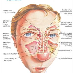 Etiologia Sinusitis 