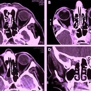 Head Sinusitis 