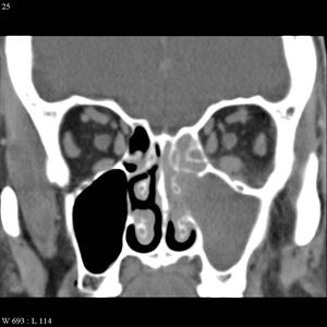 In The Sphenoid Sinuses - Sinus Infection - Information On Sinus Infection