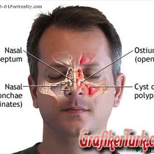 Sinusitis Alergia - Don