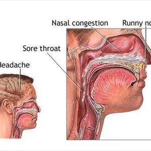 Akute Sinusitis Behandlung 