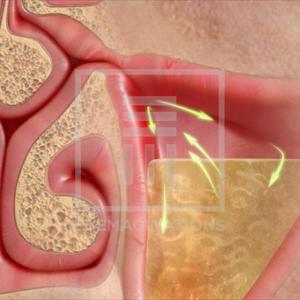 Sphenoid Sinuses Anatomy - Maxilliary Sinus Disease - The Ways To Get Over Maxillary Sinus Disease