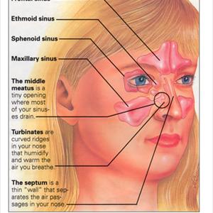 Sinusitis Common - Recurring Sinus Infection - An Explanation?