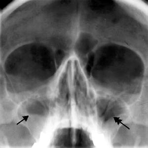 Sinusitis Aguda Ni?Os 