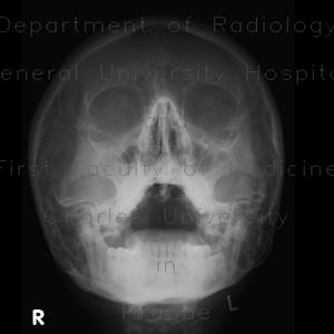 Sinusitis Casero 