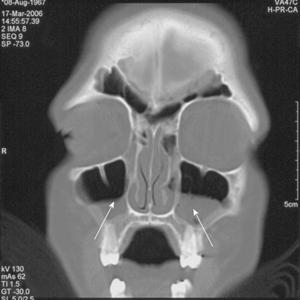 Ammonia Smell Sinuses - Spotting A Sinus Infection Symptom Right Away