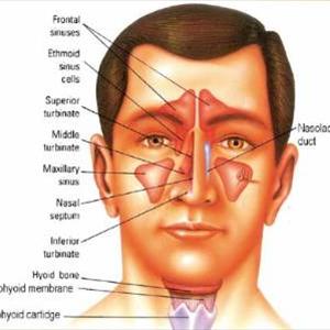 Right Sphenoid Sinusitis 