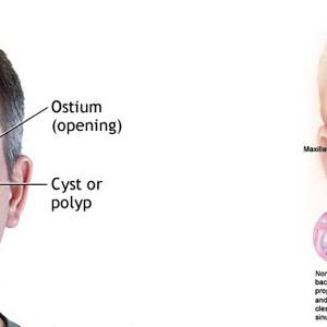 Sinuses 