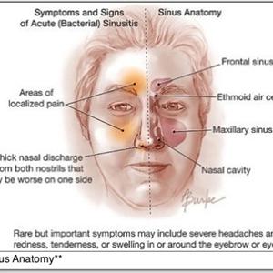 Sinusitis Herbal Cure - Home Remedies For Sinus Problems - How Home Remedies Can Keep Sinus Problems At Bay