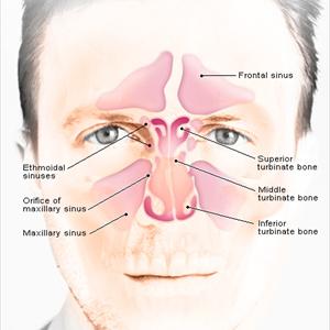 Sinusitis Maxilares 