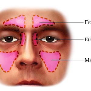 Severe Sinus Infection 