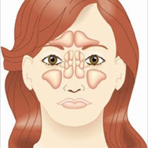 Sinus Cysts - Sinusitis: General Information About Treatment