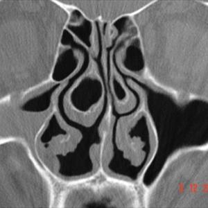  Sinus Pain Treatment 