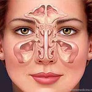 Sinusitis Medicina Alternativa 