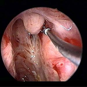 Maxillary Sinuses Treatment - Antibiotics Can Cure Sinusitis