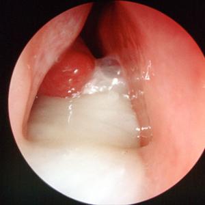 Chronic Sinusitis Thyroid - Sinus Infection In Children