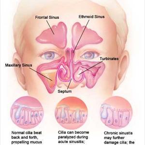 Black Eyes Sinusitis - Treatment Of Your Sinusitis