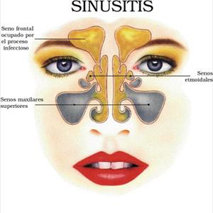 Pressure Sinuses Burning 