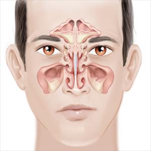  Maxilliary Sinus Disease 