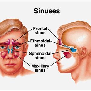 Nasal Passages Sinuses - Sinus Infection Problems- Sinusitis