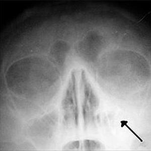 Sinus Treatments - Causes Of Maxillary Sinus Disease