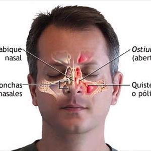 Sinus Tinnitus Treatment 