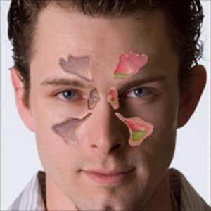 Ethmoidal Sinus - Treating Sinus Infections