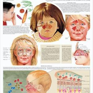 Fungal Sinusitis Mucus 