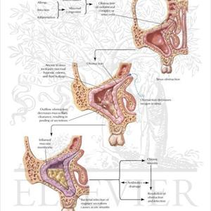 Maxillary Sinusitis 